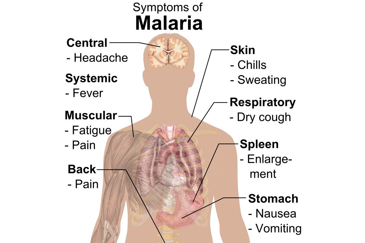 Mengenal Gejala Malaria pada Tubuh