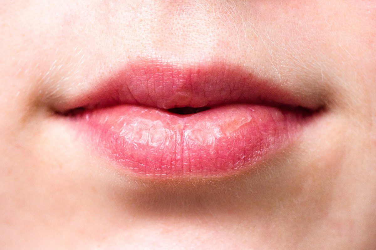 7 Penyakit yang Ditandai dengan Bibir Pecah-Pecah
