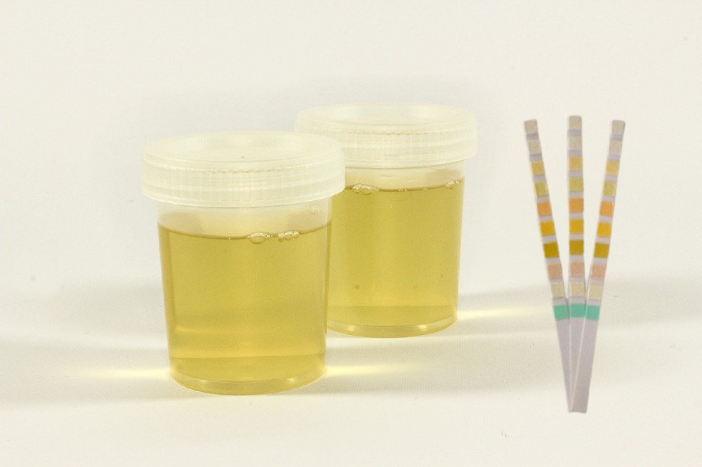 Mengenal Jenis Warna Urine untuk Indikasi Kesehatan Tubuh