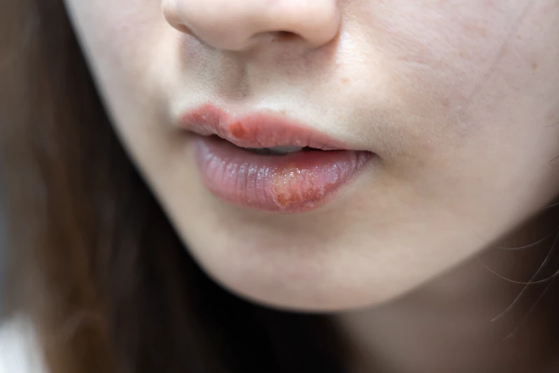 10 Penyebab Bibir Bengkak dan Cara Mengatasinya
