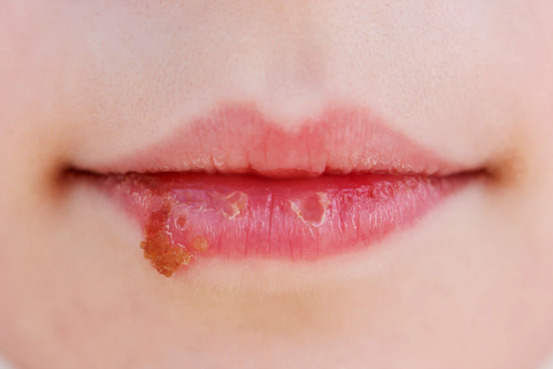 Bibir Kering Saat Puasa? Ini Penyebab & Solusinya
