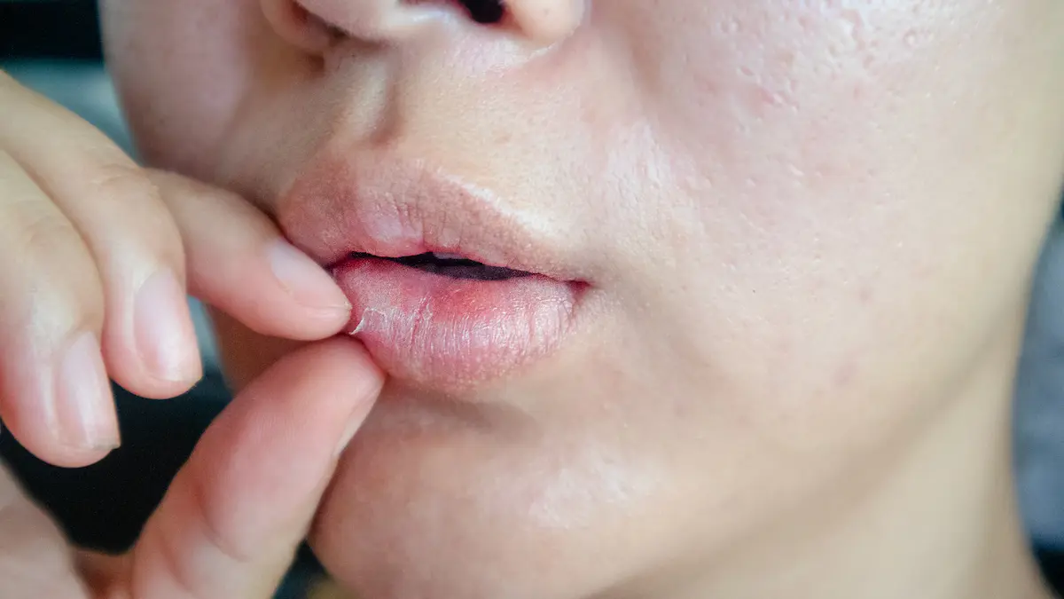 Kenapa Ada Bintik Putih di Bibir? Berikut 9 Penyebabnya