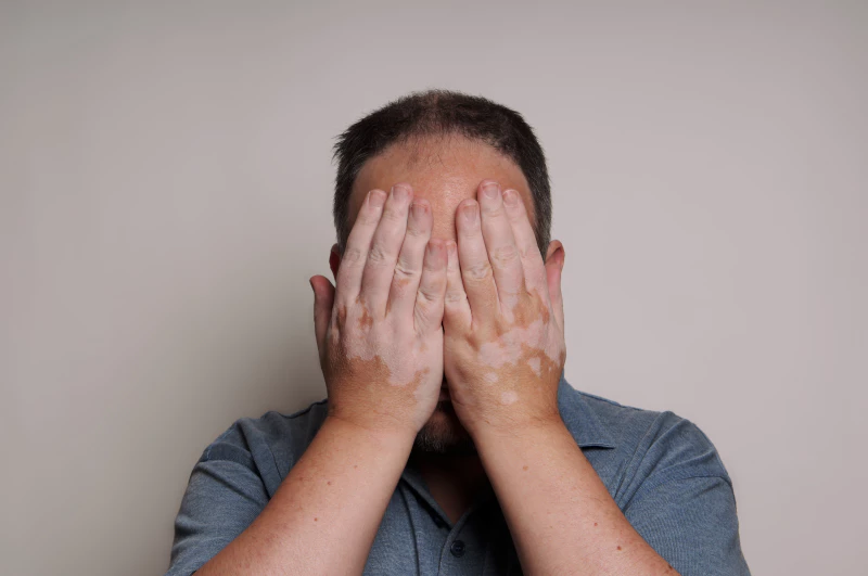 13 Cara agar Vitiligo Tidak Menyebar serta Penyebabnya