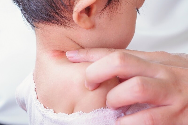 Jangan Panik, ini 7 Cara Mengatasi Biang Keringat pada Bayi