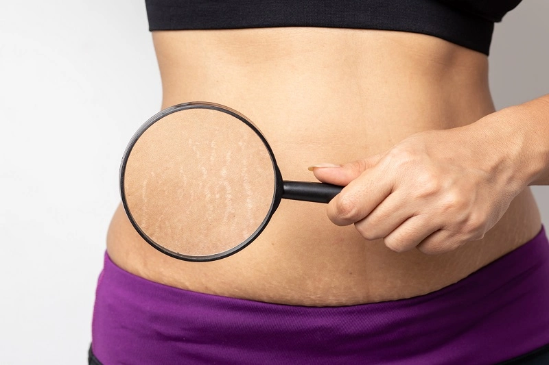 9 Cara Menghilangkan Stretch Mark Secara Alami