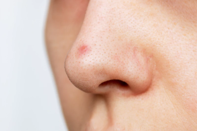 7 Penyebab Jerawat di Hidung dan Cara Mengatasinya!