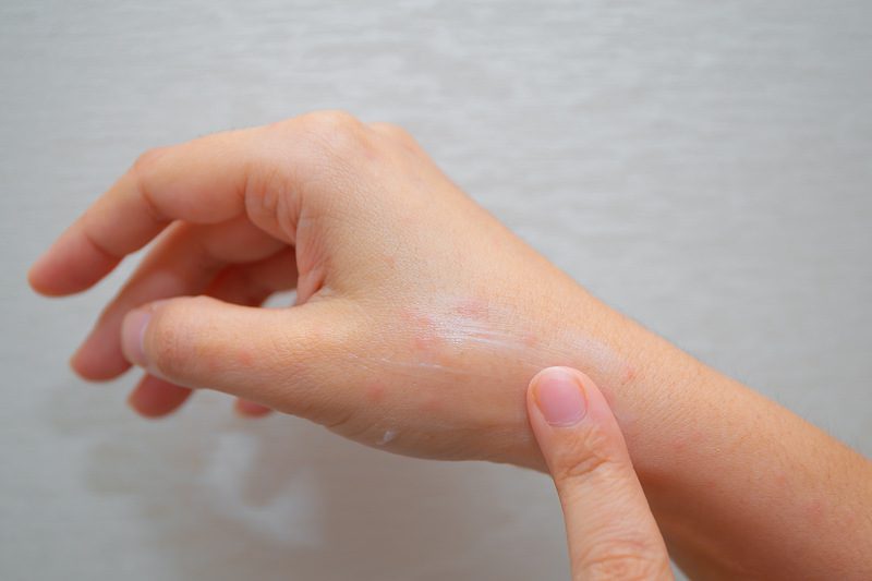 4 Rekomendasi Lotion Nyamuk Aman untuk Kulit Sensitif Anak