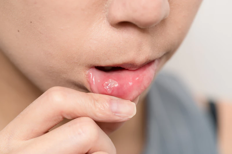 5 Penyebab Sariawan di Bibir dan Cara Mengatasinya