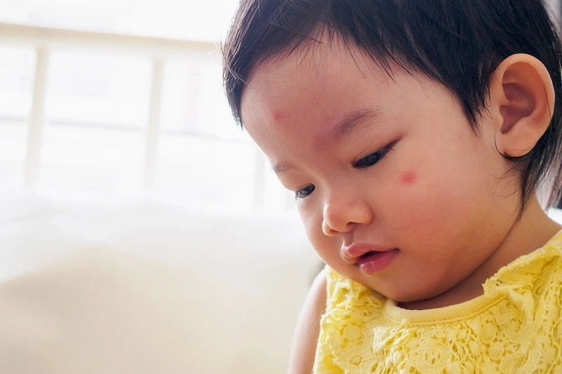 Rubella: Penyebab, Gejala, Pencegahan, dan Cara Mengobati